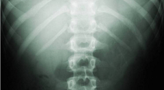 spine xray